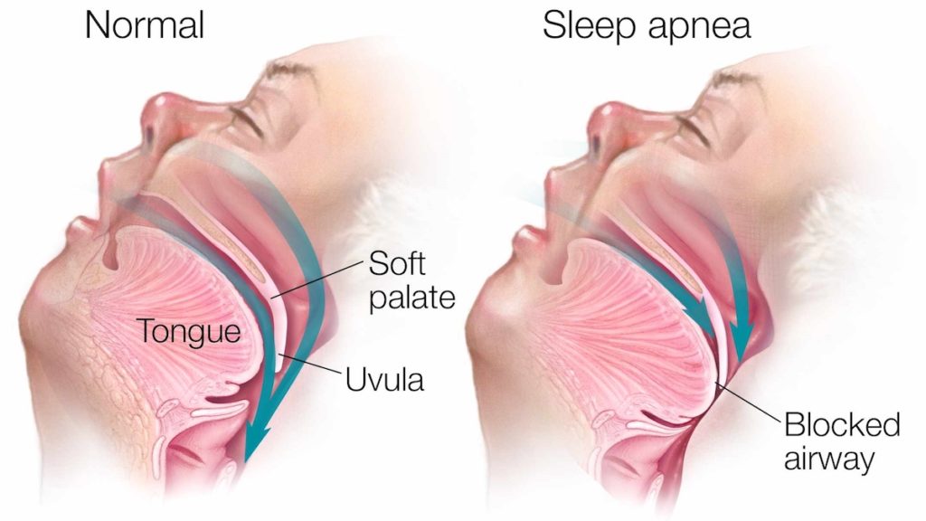 What is the Main Cause of Sleep Apnea? - Sleep Care Online